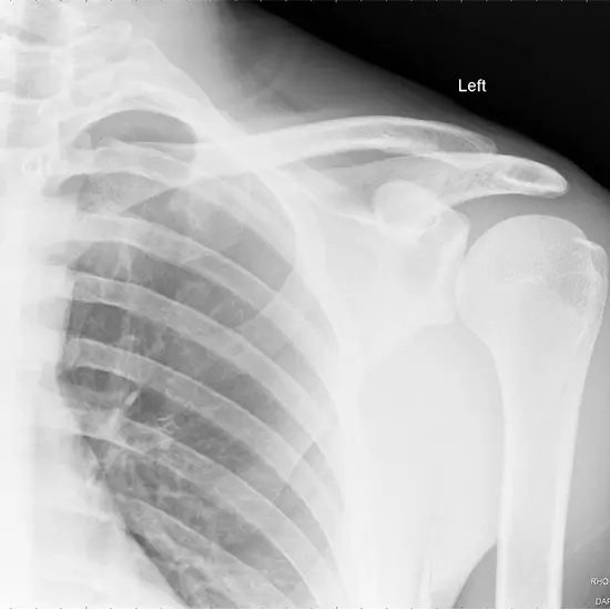X-ray Right Scapula AP/Lateral